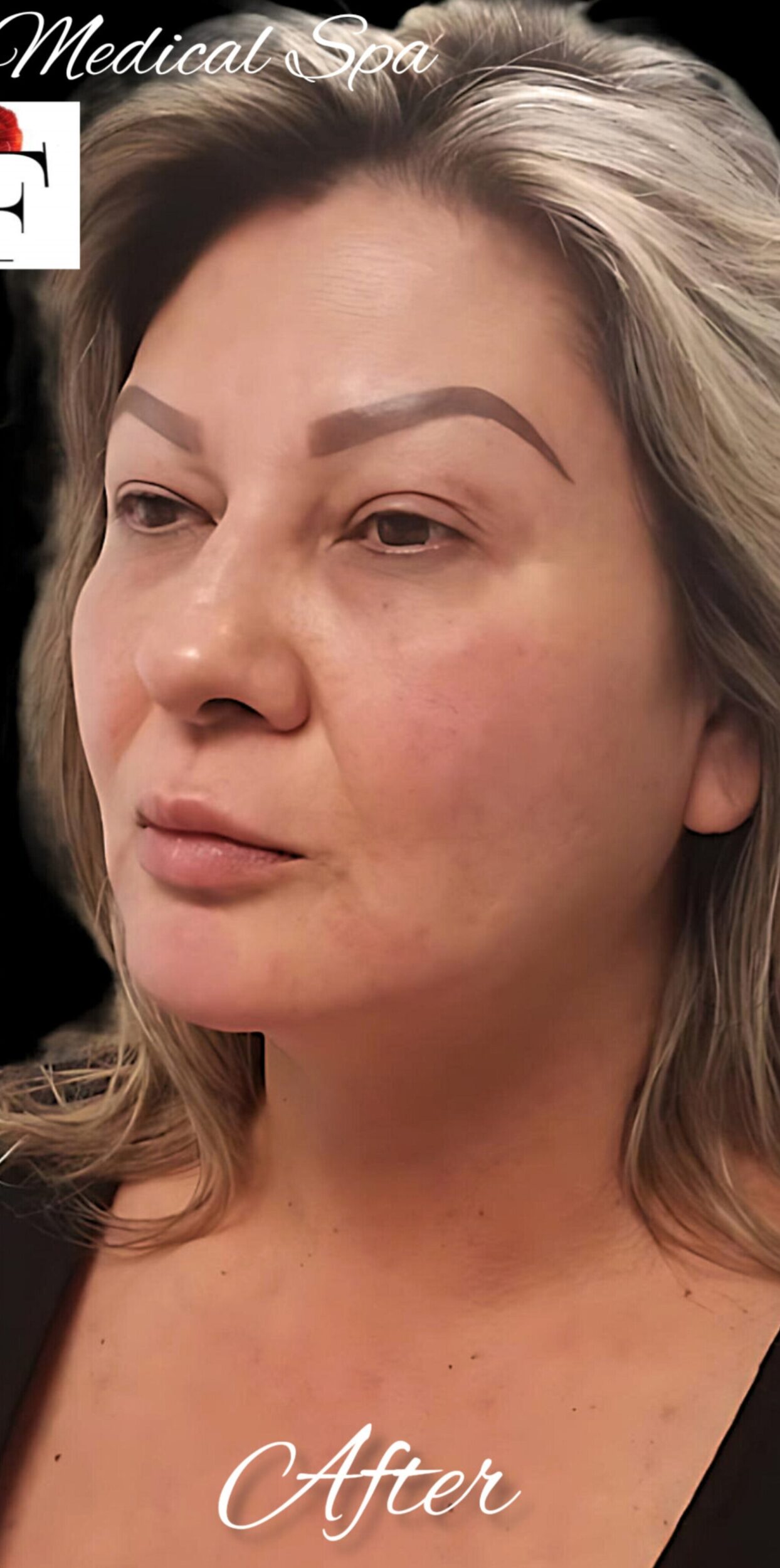 After Image: PDO Thread Lift - left-front-oblique