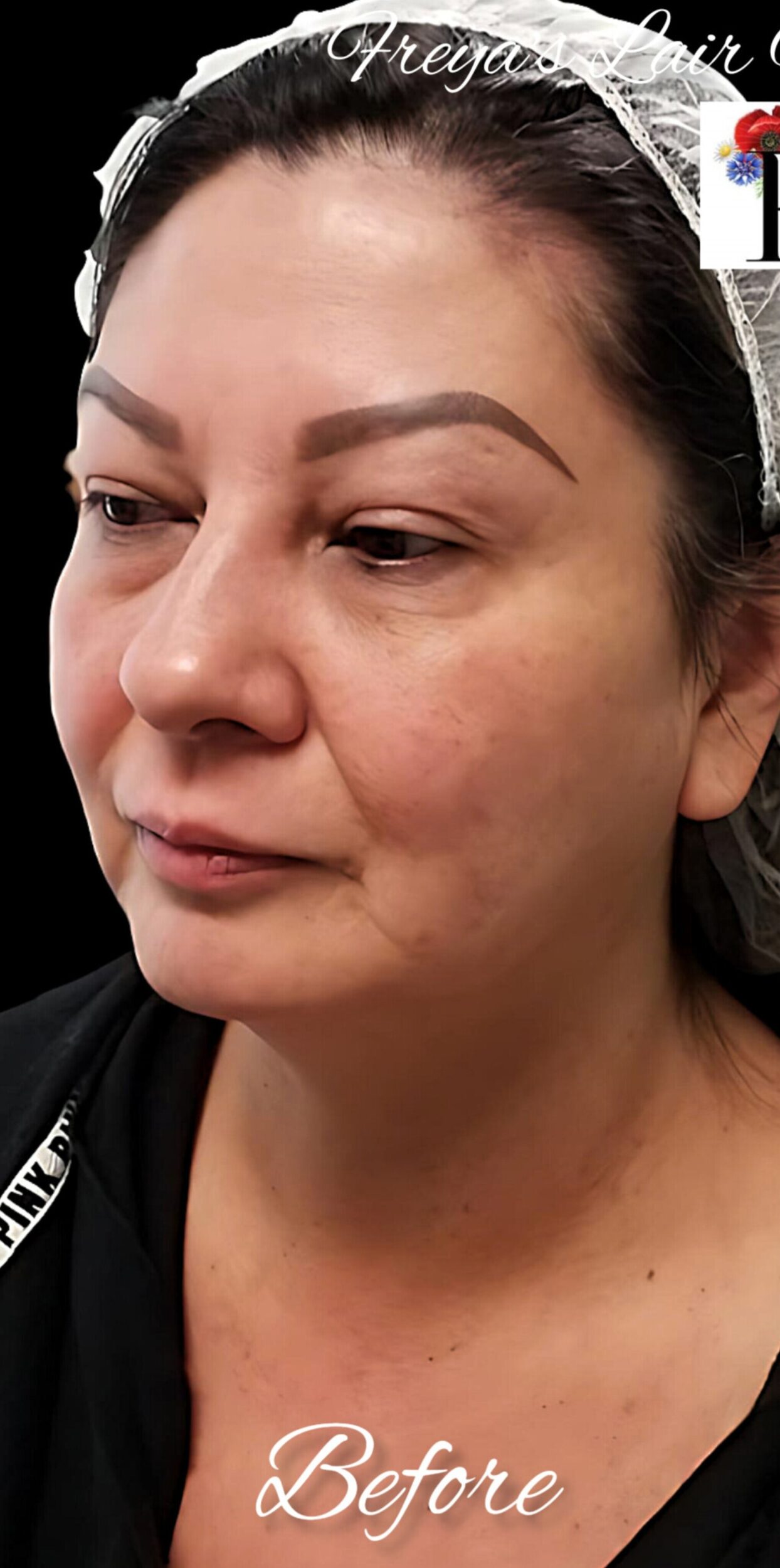 Before Image: PDO Thread Lift - left-front-oblique