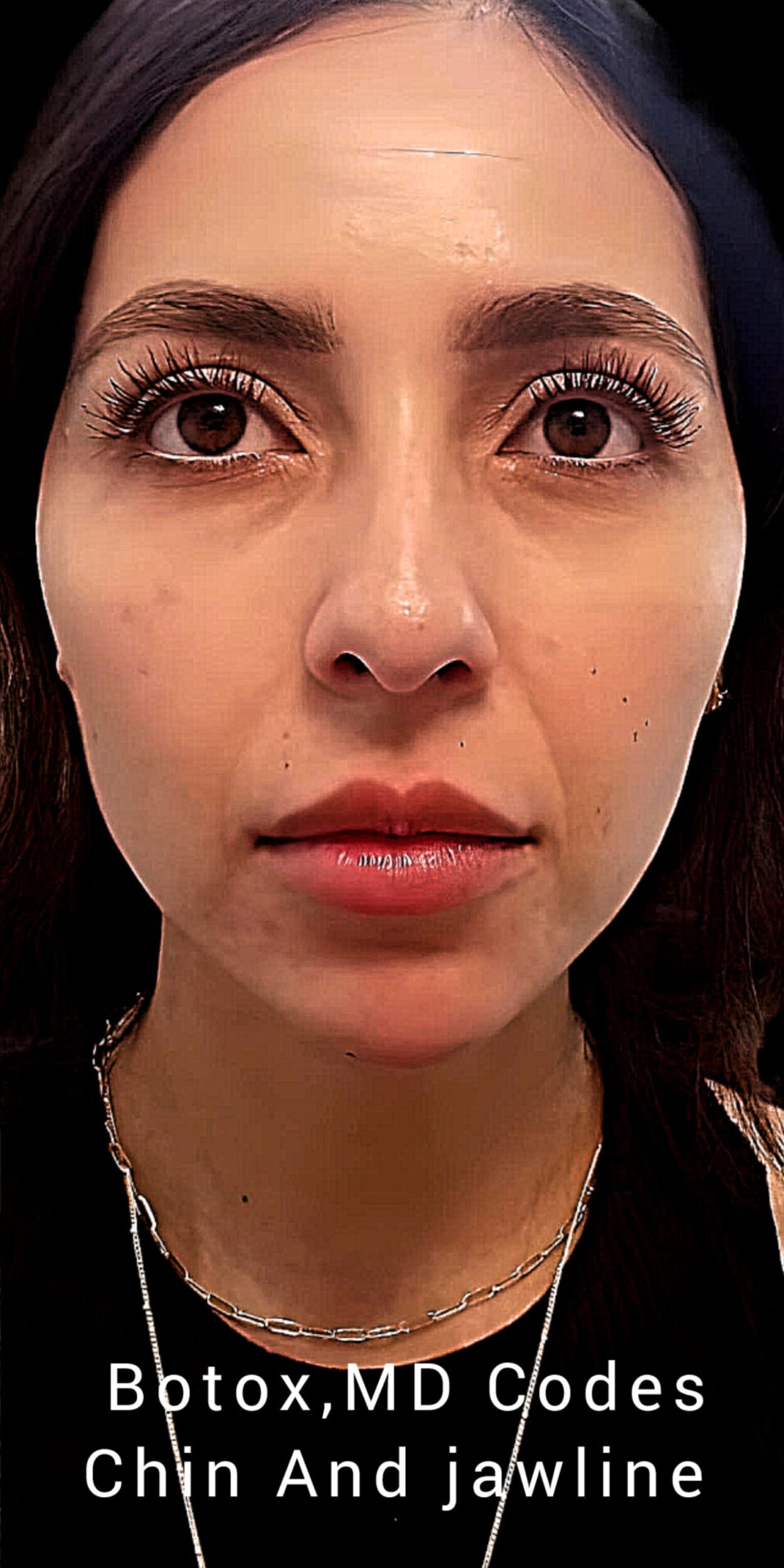 After Image: Botox - front