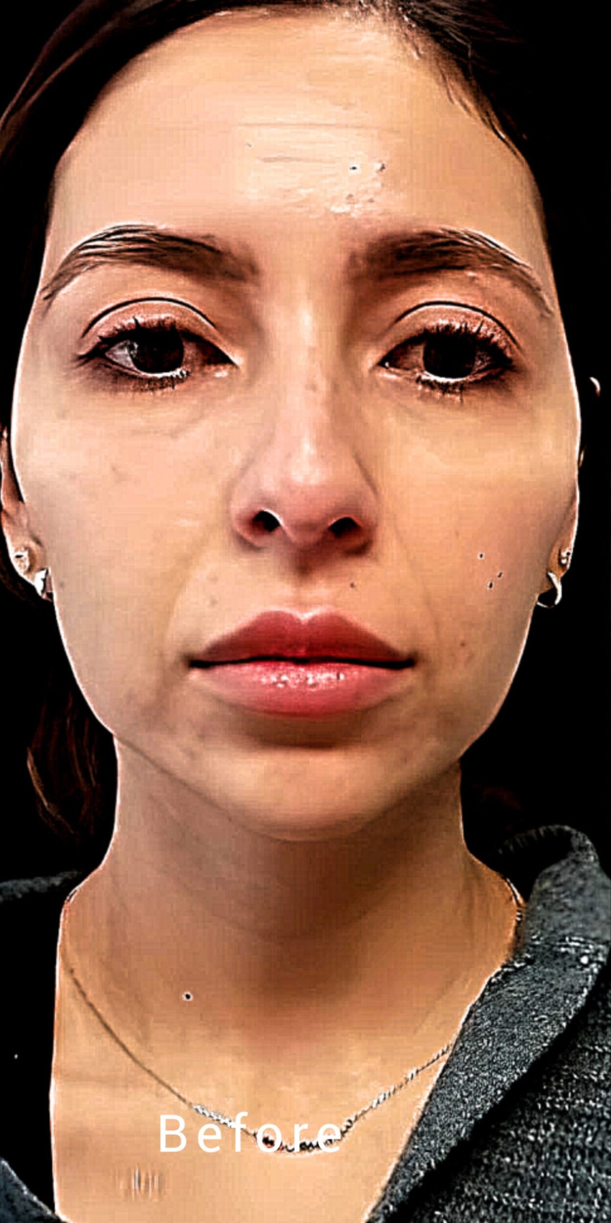 Before Image: Botox - front