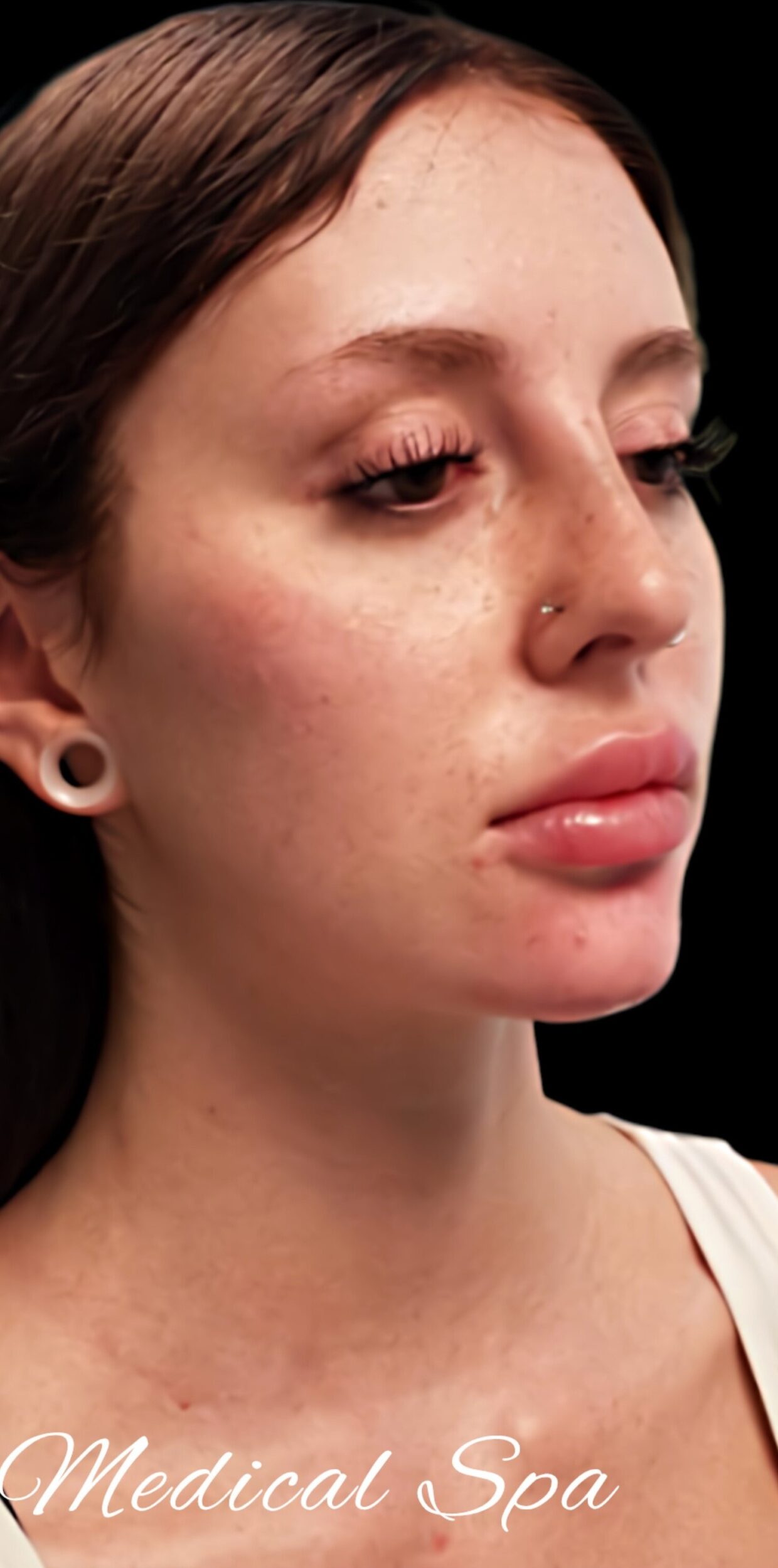 After Image: Chin and Jawline Filler - right-front-oblique