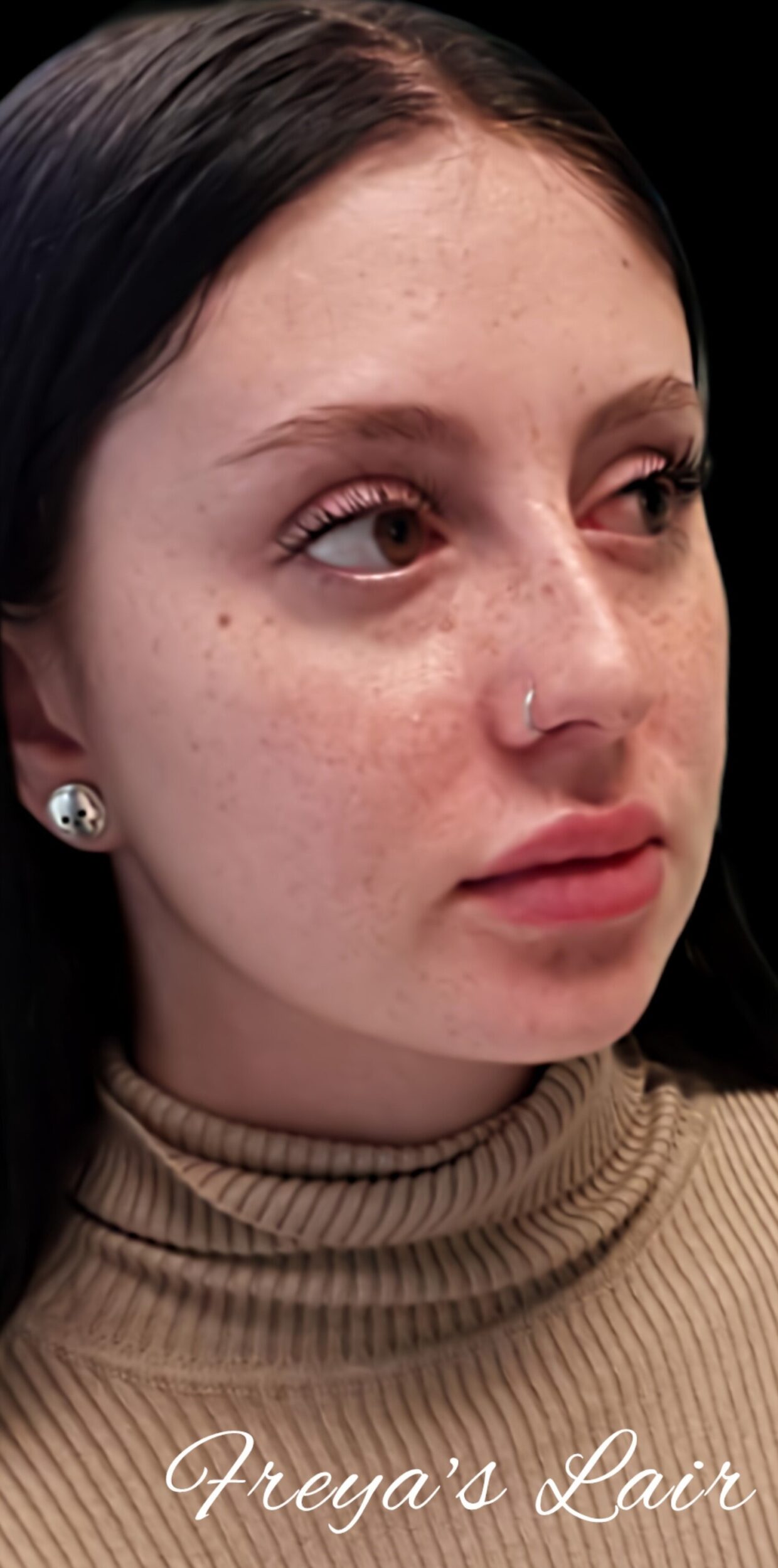 Before Image: Chin and Jawline Filler - right-front-oblique