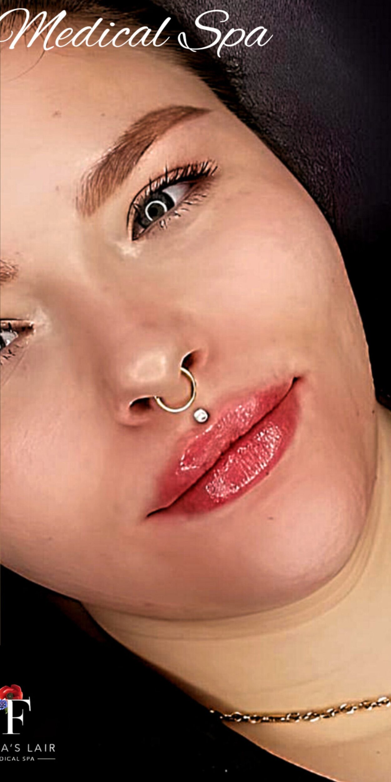 After Image: Lip Filler - right-front-oblique