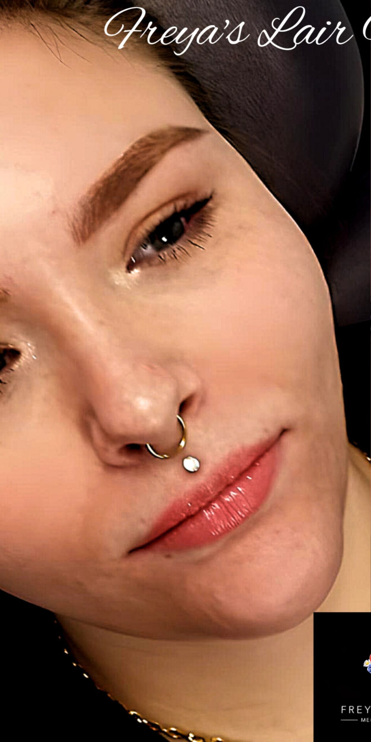 Before Image: Lip Filler - right-front-oblique