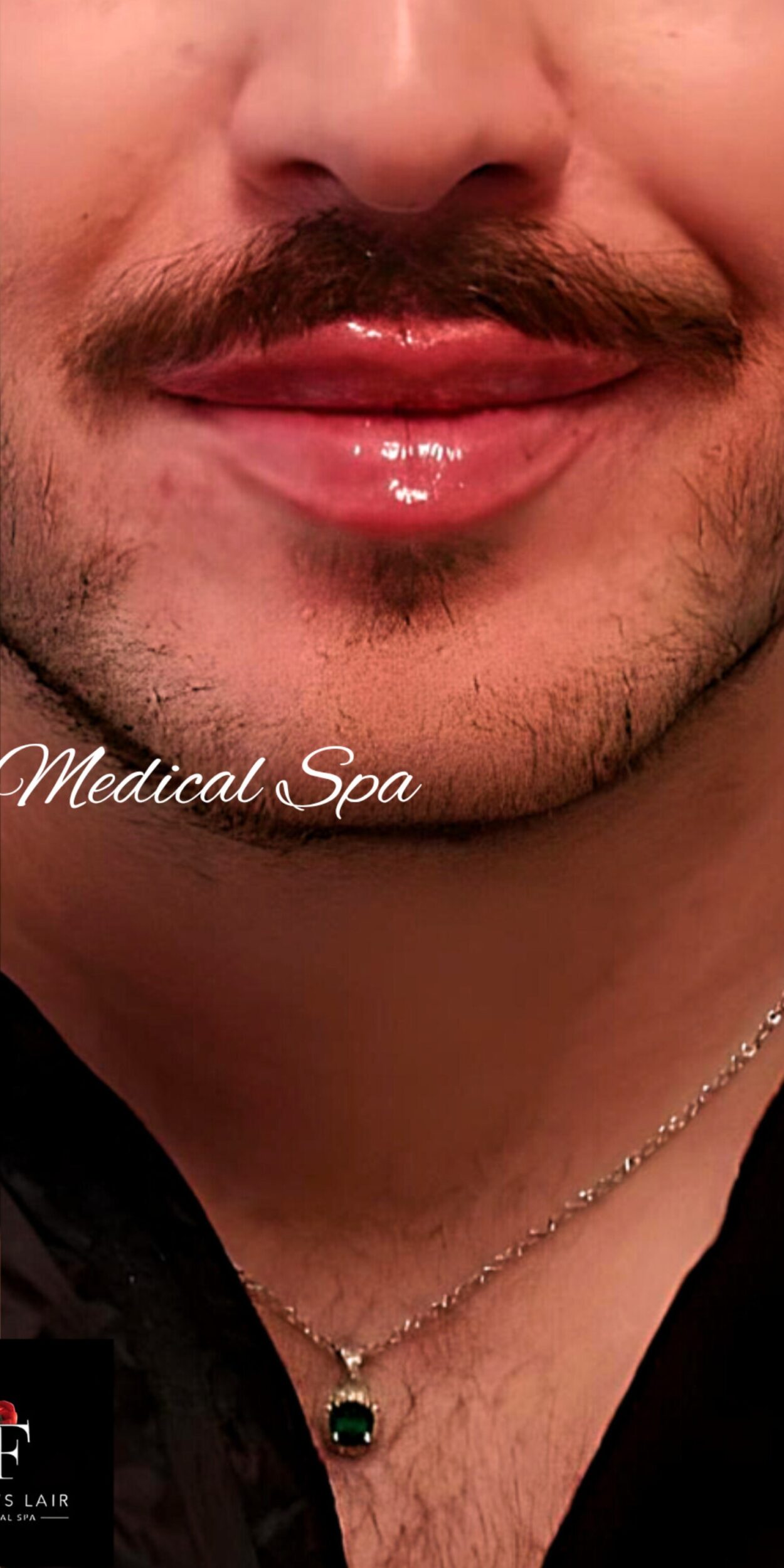 After Image: Lip Filler - front