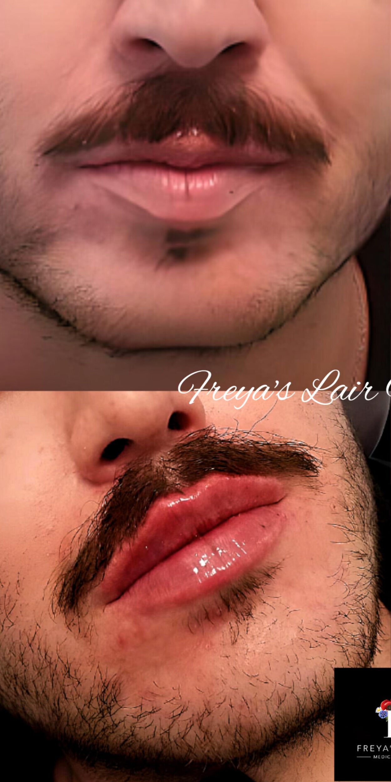 Before Image: Lip Filler - front