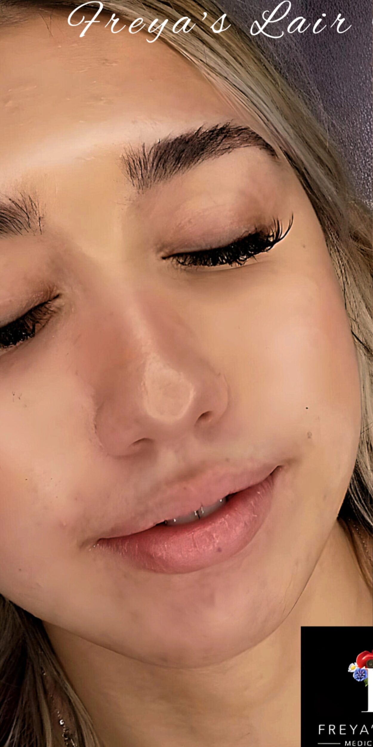 Before Image: Lip Filler - right-front-oblique