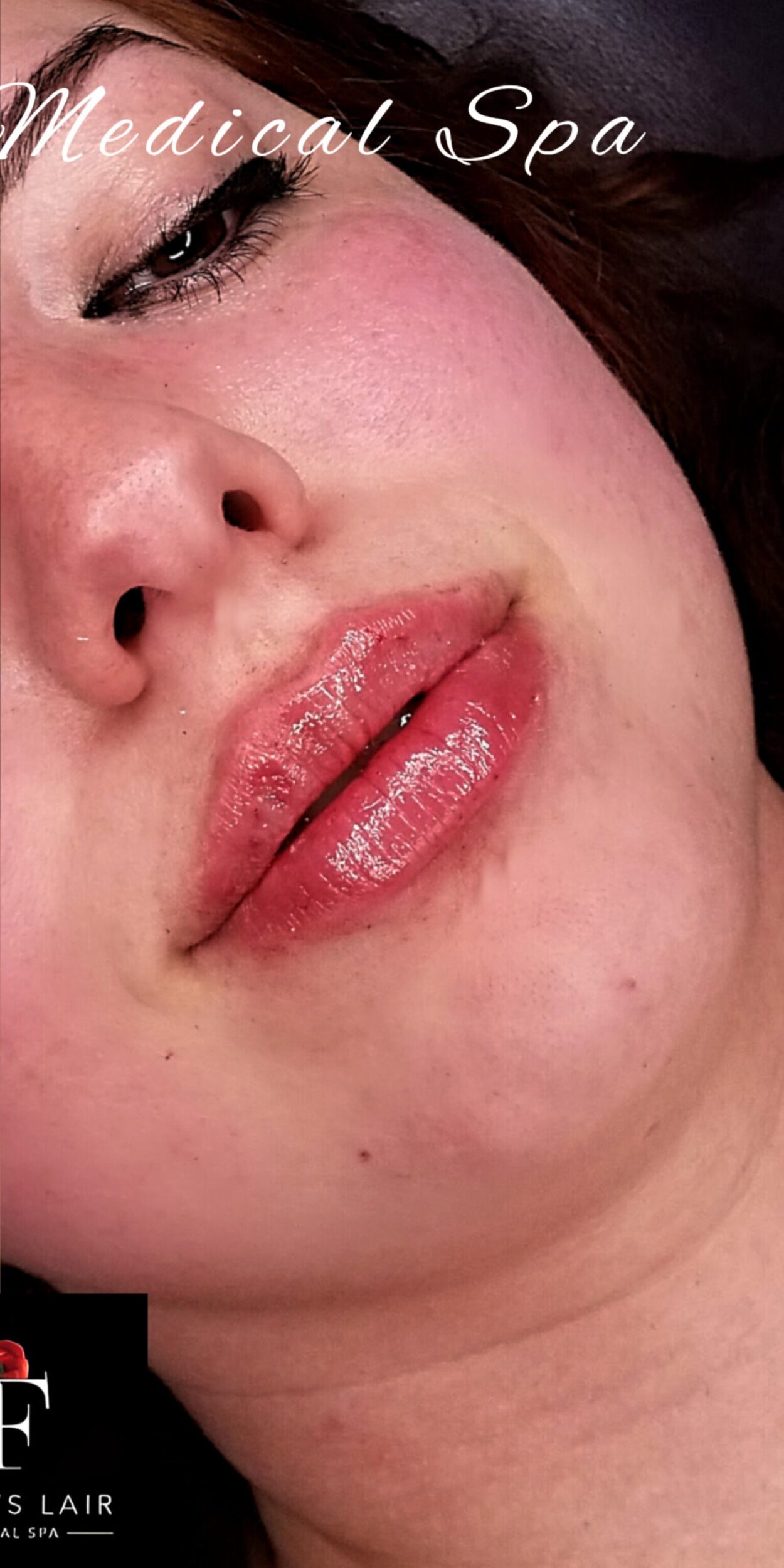 After Image: Lip Filler - right-front-oblique