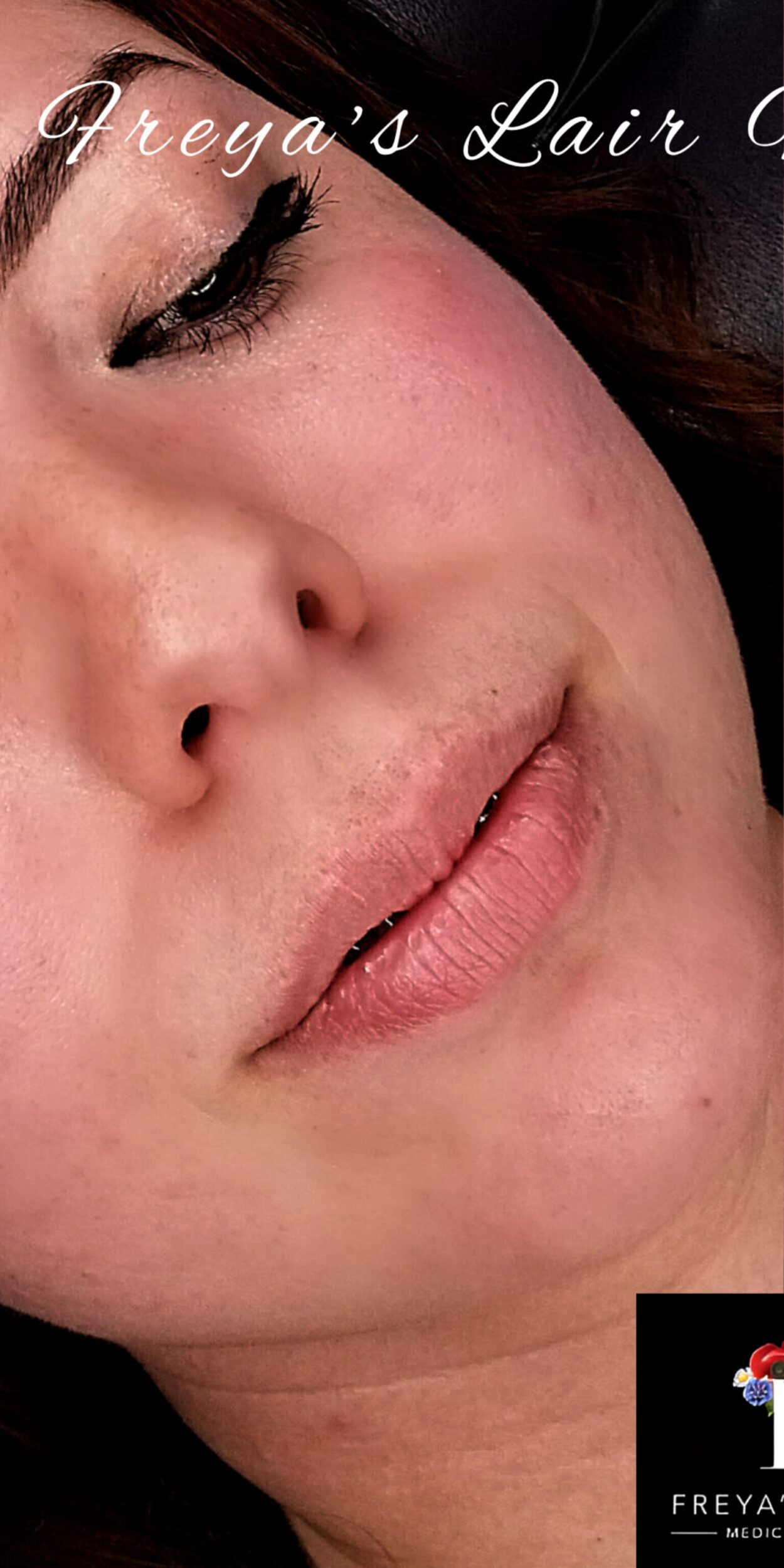 Before Image: Lip Filler - right-front-oblique