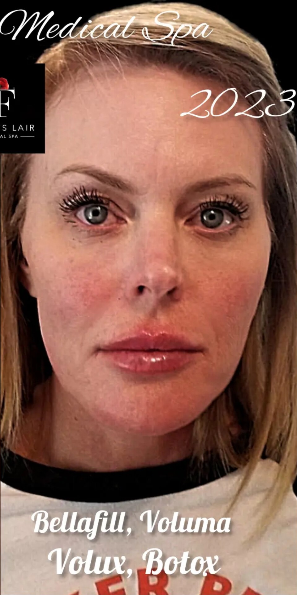 After Image: Liquid Facelift - front