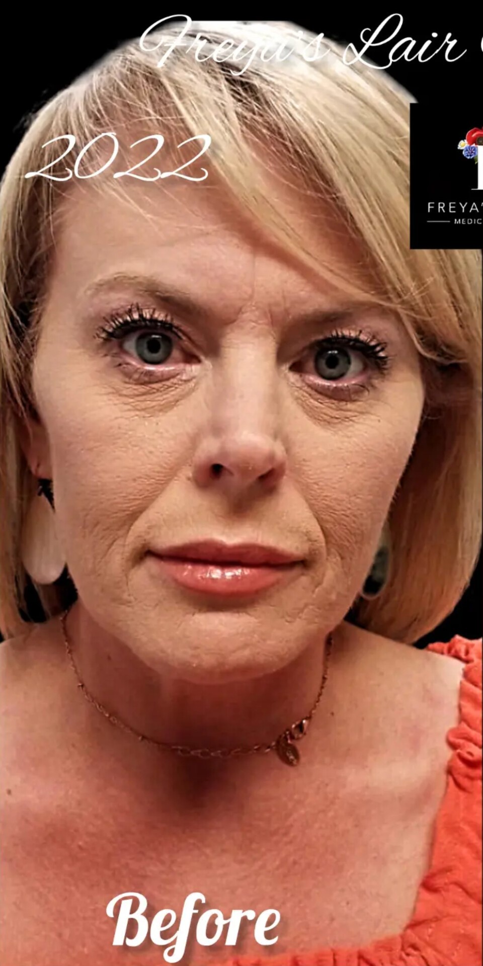 Before Image: Liquid Facelift - front