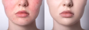 shutterstock 2281688097 768x261.jpg 1 IPL for Rosacea: Can It Really Help Redness?